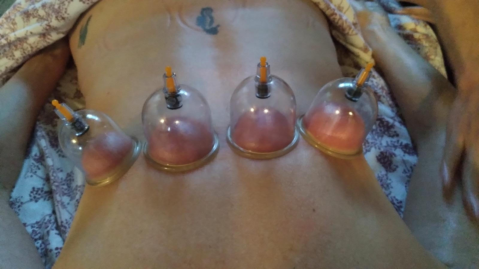 Cupping